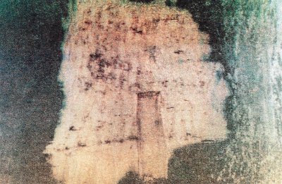 Göçüren hastalığı